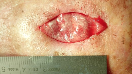 Fitting of the matrix.