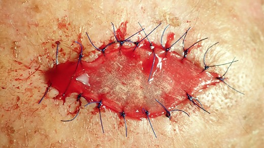 The matrix is fixed on the defect with 6.0 Sabafil sutures.