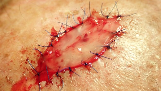 The collagen matrix is enriched with I-PRF. After centrifugation according to Coukroun’s protocol, I-PRF is derived from the patient’s blood. In this case, it is used to promote tissue healing.