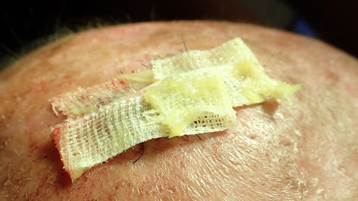 Stripes with Aureomycin (Chlortetracycline) are used to cover the defect. The patient was provided with postoperative care instructions, including wound care, hygiene, and the importance of follow-up appointments for monitoring and evaluation.