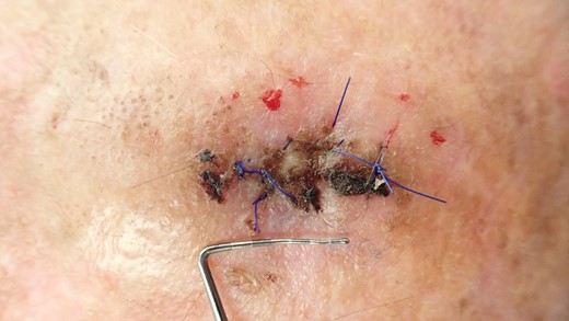 Clinical situation after 10 days; stitches will be removed at this appointment.