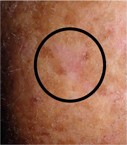 Situation 3 months after surgery. For patients with a large area of highly sun affected skin, it would be difficult to create a sufficient flap mobilization because of scars and to avoid camouflage of any lesions.