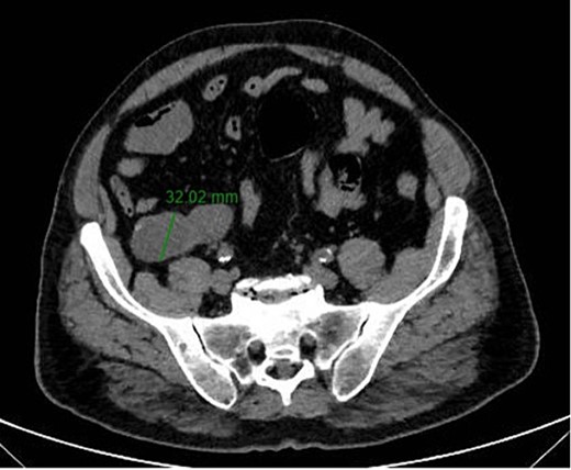 Axial CT-scan highlighting the AM.