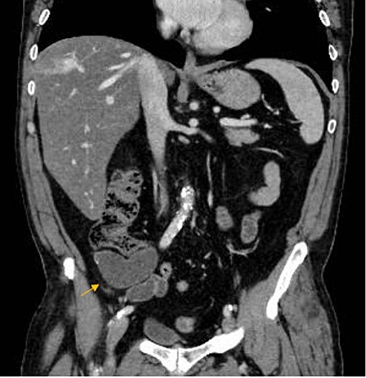 AM on coronal CT-scan.