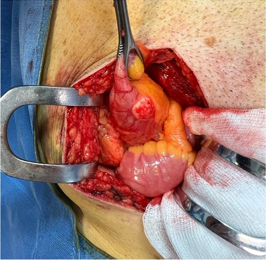 Intraoperative findings showing pathologic appendix and whitish neoformation in site compatible with mucocele.