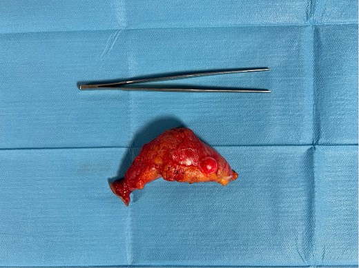 Surgical piece illustrating the appendicular mucocele after stapled appendectomy and tangential resection of the cecum base.