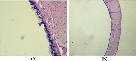 Microscopic appearance of mucinous cystadenoma of the appendix. (A) Proliferative and partially papillary configuration of the mucosa; haematoxylin and eosin, magnification ×20. (B) Evidence of flattened mucosa accompanied by atrophy, fibrosis and chronic inflammation of the underlying wall; haematoxylin and eosin, magnification ×10.