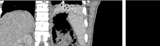 CT images of the abdomen (venous phase) revealed a protruberance in the left inguinofemoral region extending into the retroperitoneal space, progressing as a perirenal abcess, spreading to the left sub-diaphragmatic region and causing an air-fluid level and an infiltrate in the lower lobe of the lung.