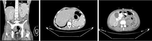 Postoperative CT done on the fourth day after surgery revealed a significant reduction in abcess size and improvement of the left lower lung lobe infiltration.