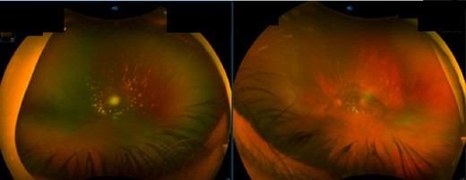 Fundal image of right and left eye. Right eye: large PVD with opacification and some vitreous cells. Left eye: nuclear sclerosis of intraocular lens and large PVD with opacification.