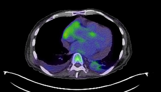 PET-CT imaging indicating pericardial and pleural involvement of lymphoma.