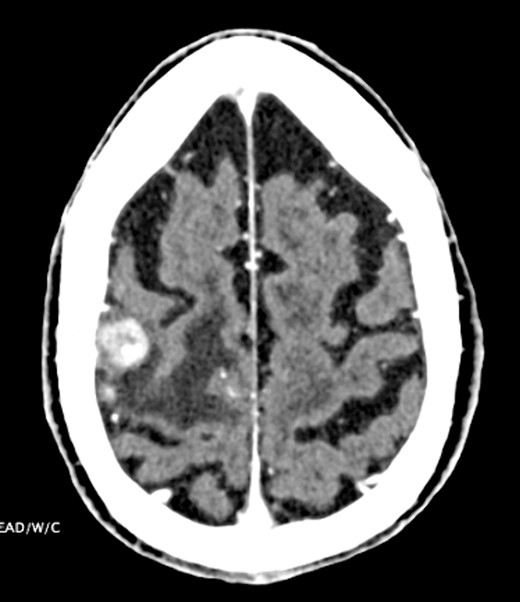 CT head indicating 1.3-cm right frontal lobe motor cortex heterogeneously enhancing lesion.