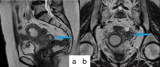 Preoperative MRI imagines; (a) sagittal; (b) coronal; alterations in the left fallopian tube, enlargement of the uterine cavity and cervical canal, and soft tissue hyperplasia within the uterine cavity.