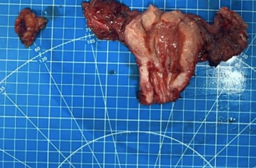 The obturator lymph node, uterus, and fallopian tube from the patient were received, revealing a significant tumor presence.