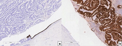 Immunohistochemical examination of the fallopian tube tumor; (a) with antibodies to CK 7, 100× magnification; (b) with antibodies to CDX 2, 100× magnification, and IHC analysis revealed positive CK 7 expressions in the preserved endometrium, while expression was notably absent in the tumor cells; conversely, positive CDX 2 expression was observed in the tumor cells, with an absence of expression noted in the endo-salpinx.