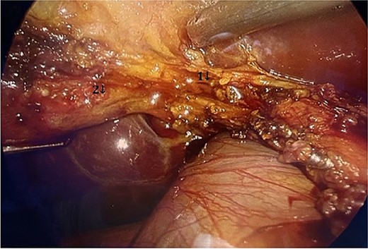 Visualization of the biliary lesion; (1) tangential damage to the right hepatic duct; (2) gallbladder with lateral traction.