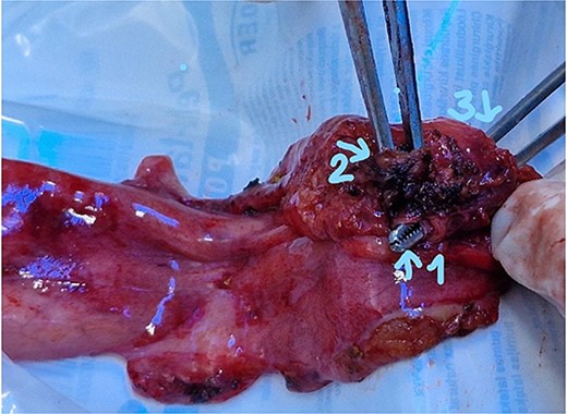 Gallbladder (1) distal part ot the cystic duct; (2) the part connecting with the right hepatic duct; (3) entrance to cystic duct from the lumen of the gallbladder.