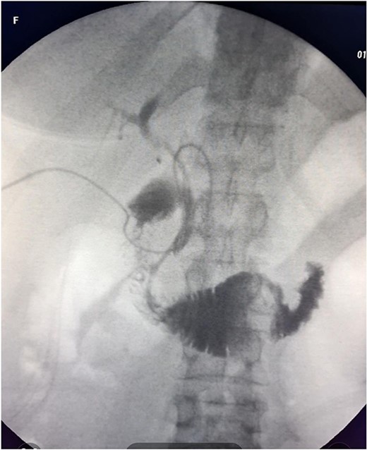 Postoperative transdrainage cholangiography.
