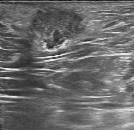 Transperineal ultrasound showed a 1.5 cm size irregular mixed echogenicity lesion.
