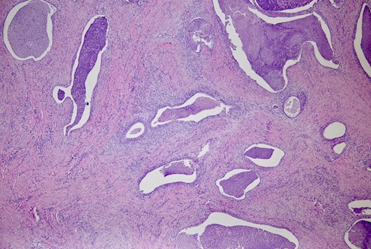 The perineal tissue shows several irregularly dilated endometrial glands along with stroma. (H&E, ×40)