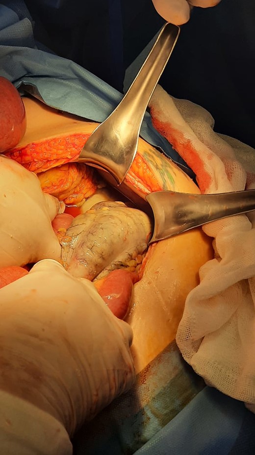 Distended loops, devitalized tissue, and areas of necrosis.