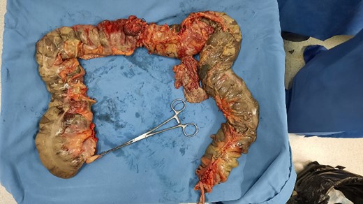 Segment resected and sent to pathology, who reported acute and chronic nonspecific inflammation, necrosis with detachment, and ulceration of the mucosa, as well as diffuse hemorrhage.