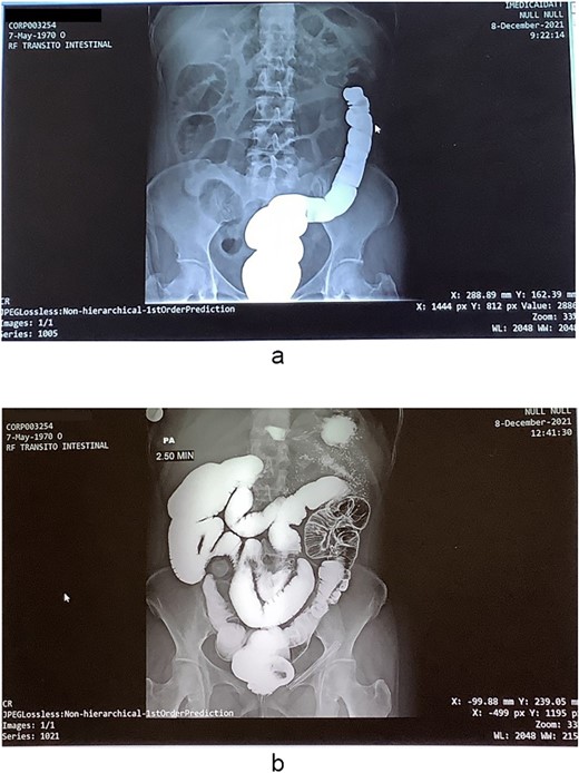 (a) Colonic enema imaging to assess intestinal transit, (b) a generalized expansion of both the small and large intestine is revealed, showing the presence of preponderant hydro-aerial levels in the colon.