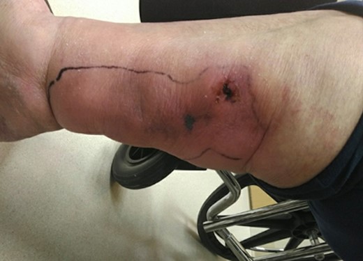 Initial presenting wound on medial aspect of right lower extremity.