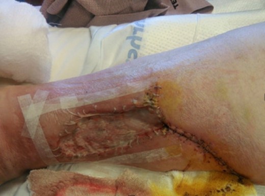 Wound post skin graft and debridement.