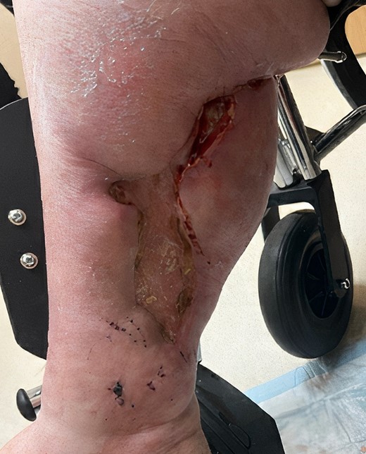 Three months postskin graph and reinitiating of STS therapy.