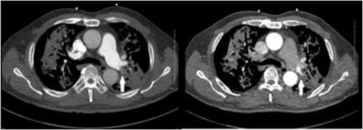 CT pulmonary angiogram (left) demonstrates non-opacifying segmental pulmonary artery (white arrow); on the CT systemic arterial phase angiogram (right), the same segmental pulmonary artery opacifies; background cavitating consolidation is seen in both lungs.