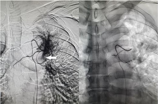 Fluoroscopic image of bronchial artery catheterization and angiogram (left); flow of contrast into the pulmonary artery branch (white arrow) which quickly dissipates, and postembolisation image (right) with microcoils in the treated artery.