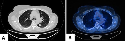 Pulmonary meningioma in segment VI of the left lower lobe in axial view in (A) CT scan showing a well-circumscribed/bordered homogenous, solid, noncalcified lesion; (B) PET-CT scan showing minimal metabolic activity.