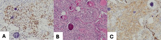 (A) Meningothelial cells with some psammoma corpuscles; magnification 100×; (B) Image EMA: immunohistochemical positivity for EMA, and magnification 100×; (C) progesterone image: immunohistochemical positivity for progesterone; magnification 100×.