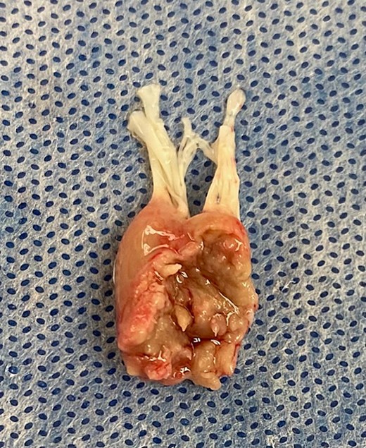 Intra-operative view of papillary muscle complete rupture.