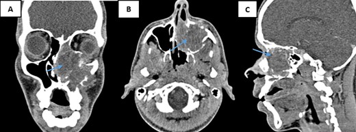 CT scans of the facial mass in coronal (A), axial (B), and sagittal (C) reconstructions were performed after the injection of iodinated contrast medium. The scans show a tumor (60 × 47 × 46 mm) on the left side (arrow) with hypodense tissue density. The tumor is heterogeneously enhanced after contrast injection and involves the nasal cavity and ipsilateral maxillary sinus, with aggressive infiltration of surrounding structures.