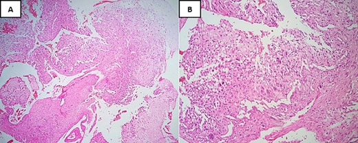 Hematoxylin and Eosin stain (H&E) under low-power magnification reveals: (A) areas of necrosis accompanied by a spindle cell tumor and chondroid nodules located at the periphery (×4). (B) Neoplastic cells typically demonstrate severe anaplasia and pleomorphism, and they are fusiform, plasmacytoid, and epithelioid merging with neoplastic cartilage (×20).