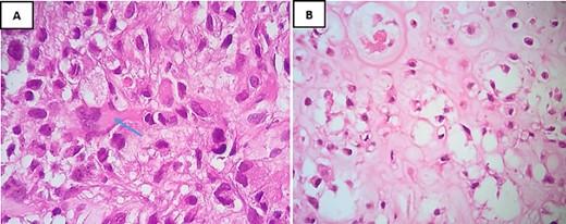 H&E staining under high-power magnification highlights: (A) within the spindle cell areas, tumor cells exhibit irregular hyperchromatic nuclei and brisk mitotic activity, accompanied by the production of osteoid matrix, as indicated by an arrow (×40). (B) The chondroid matrix contains neoplastic cells displaying cytological atypia (×40).