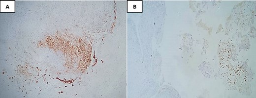 Immunohistochemical analysis showing focal staining for anti-EMA (A) and S100 (B).
