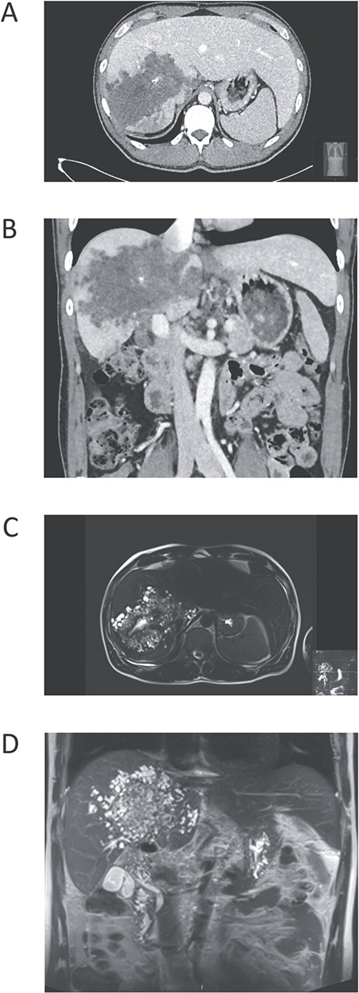 Pre-operative images of the liver. (A) Contrast-enhanced computed tomography (CT) in axial plane demonstrating a large irregular tumour mass, with central calcifications, in all segments of the right liver lobe and also affecting liver segments 1 and 4. (B) CT in coronal plane illustrating that the mass surrounds vena cava inferior. (C) Magnetic resonance imaging (MRI) T2-weighted in transversal plane depicts the typical features of Echinococcus multilocularis as a microcystic mass. (d) MRI T2-weighted image in coronal plane showing both the microcystic appearance of the tumour and also visualizing the localization above the gallbladder and the extrahepatic bile ducts.