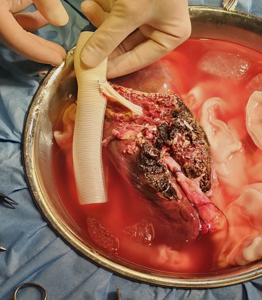 Back-table surgery on the future liver remnant (segments 2 and 3) with reconstruction of the left hepatic vein using an allograft and the retrohepatic part of inferior vena cava is reconstructed with a Dacron graft.