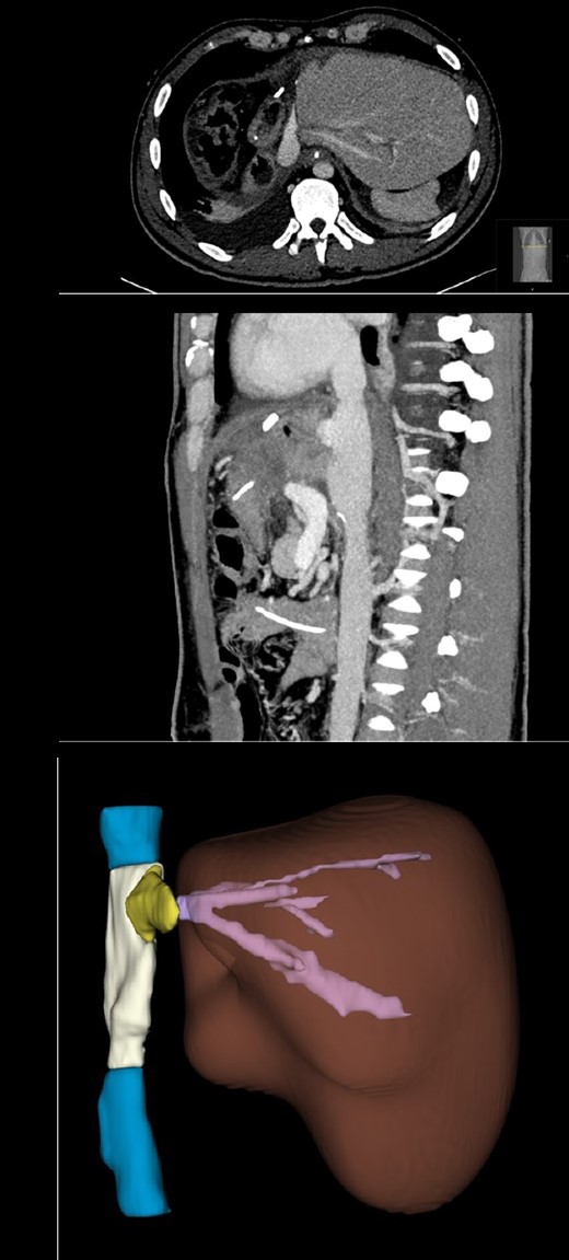 Computed tomography taken 4 weeks postoperatively. (A) CT in axial plane showing the liver remnant (segments 2 and 3) and parts of the Dacron graft in the inferior vena cava position, the left hepatic vein graft and one of the native hepatic veins of the liver. (B) CT in sagital plane showing the Dacron graft replacing the retro-hepatic inferior vena cava and the bi-caval anastomoses of the auto-transplanted liver. (C) A 3D reconstruction of the post-operative liver remnant and the iliac vein allograft (yellow) from the left hepatic veins (pink), and the inferior vena cava (blue) with the Dacron graft (white).