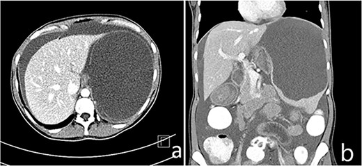 (a and b) Enlarged spleen (about 19 cm) with a large splenic cyst measuring about 15.7 × 12 × 10 cm3 with mass effect on the stomach displacing it to the right side with marked intraperitoneal free fluid seen (ascites).