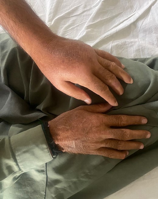 Left arm swelling compared to the right side.