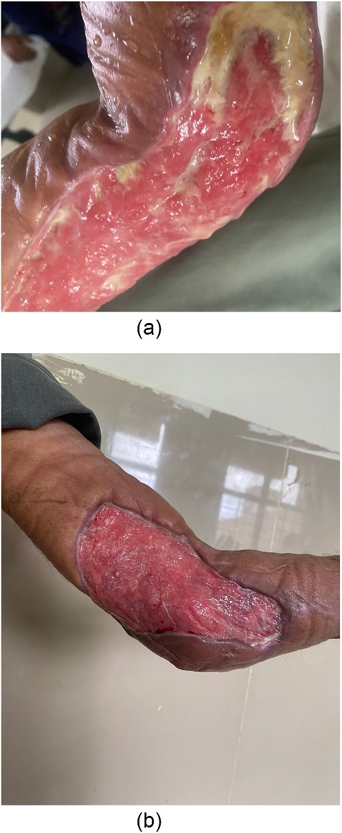 Left elbow contracture post debridement. (a) Week 2. (b) Week 6.