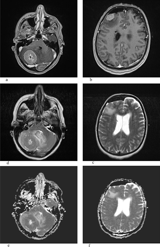 T1W with gadolinium contrast (a,b), T2W (c,d), ADC (e,f): the frontal lesion measures 1.8 × 2.1 cm (transverse plane) and 1.9 × 1.4 cm (coronal plane), while the lesion in the right cerebellar hemisphere measures 3.5 × 2.8 cm (coronal plane) and 3.9 × 3.6 cm (transverse plane), and both lesions show heterogeneous signal intensity, are surrounded by a zone of perifocal edema, and do not demonstrate that central or marginal enhancement with contrast agent in postcontrast imaging, possible necrosis, and ADC sequence shows restricted diffusion.