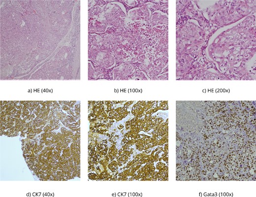 (a–c) HE, hematoxylin–eosin, PAS Alcian is a histochemical method used to demonstrate mucin production in the tumor; (d, e) CK7 and CKAE1/AE3 are antibodies for cytokeratins-intermediate filaments, parts of the cytoskeleton of epithelial cells, and (f) Gata 3 is usually positive in breast carcinomas but also in salivary gland carcinomas.