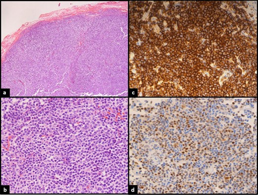 (a)Low power: neoplastic lymphoid proliferation showing vague nodular architecture. (b) High power: atypical lymphocytes are medium in size with mostly round uniform nuclei and smooth nuclear membranes. (c) CD20 strongly positive by most of the lymphoma cells confirming B lineage. (d) Cyclin-D1 positive in the lymphoma cells.