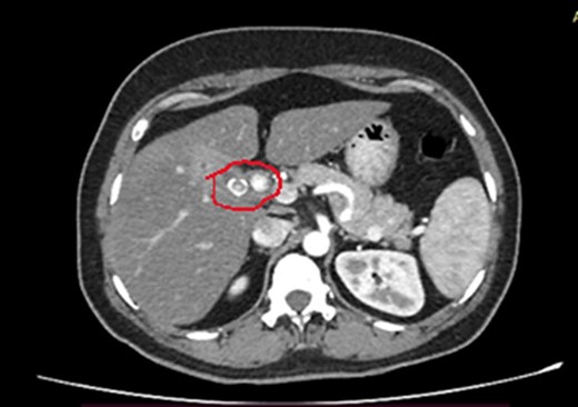 CECT of abdomen (axial plane) shows CBD stones.