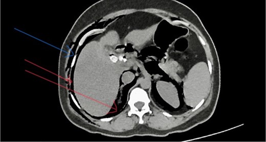 Post-ERCP NCCT abdomen shows pneumo-peritoneum (red arrow), pneumo-retroperitoneum, and subcutaneous emphysema (blue arrow)